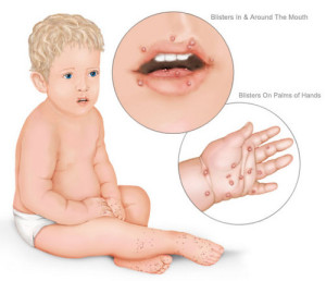 doença mãos, pés e boca no bebé