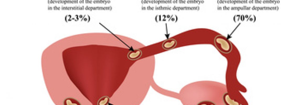 O que é a gravidez ectópica?