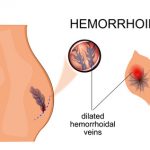 hemorróidas na gravidez