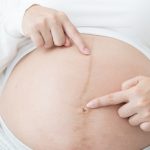 Linha escura na barriga da gestante