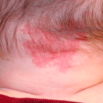 Manchas do porto no bebe