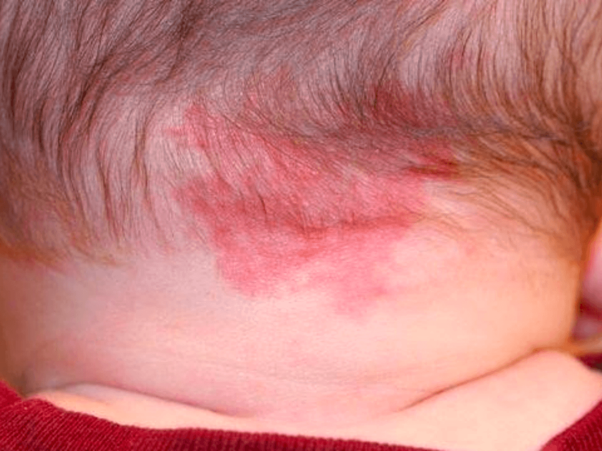 Manchas do porto no bebe