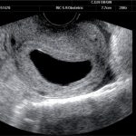 Gravidez anembrionária