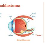 vetor Bebé com Retinoblastoma