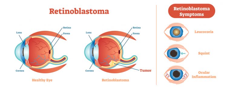 vetor Bebé com Retinoblastoma