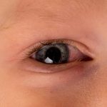 Alergia ocular infantil