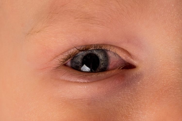 Alergia ocular infantil